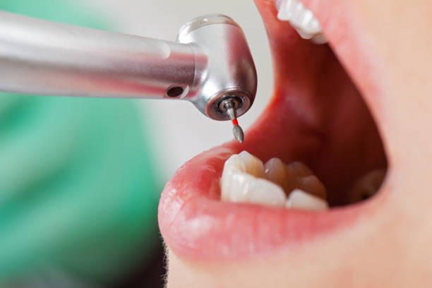 Best Knocked-Out Tooth (Avulsed Tooth) Treatment in Slayton, MN